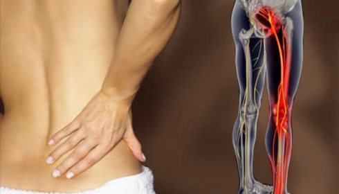Sciatica Treatment