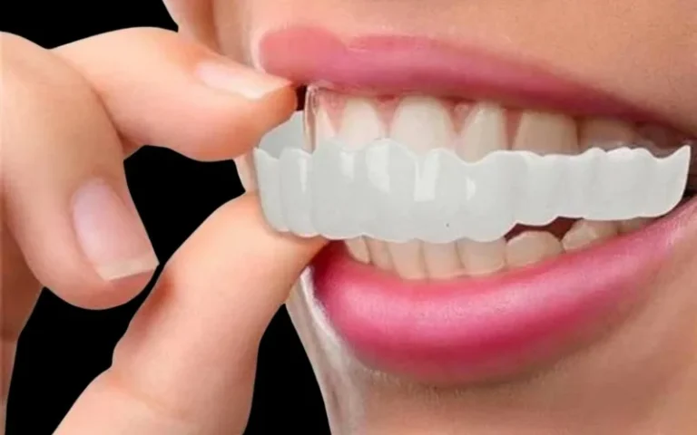 Snap-On Veneers and Oral Health: What You Should Know Before Wearing Them